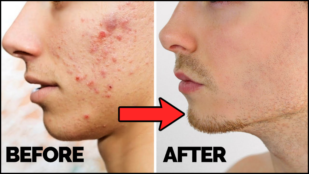 How To Remove Pimple – Acne Treatment